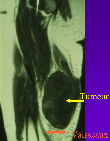 Tumeur d'un fémur