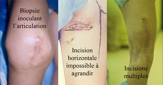 Incision et biopsie