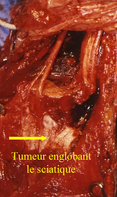 Fibrome desmoide