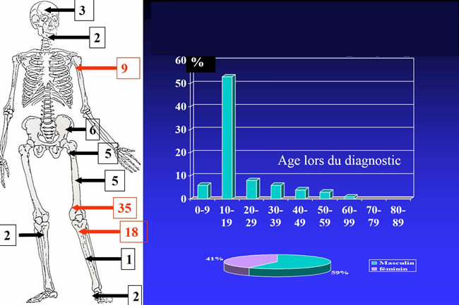 fréquence ostéosarcome