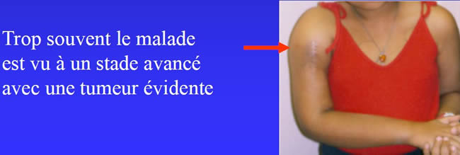 examen clinique ostéosarcome