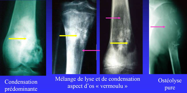 radiographies ostéosarcome