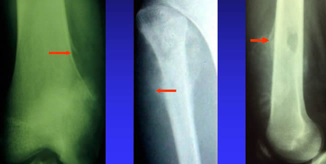 radiographies ostéosarcome