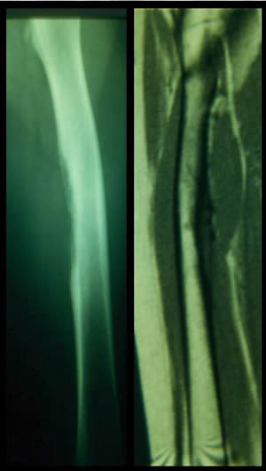 periostal ewing sarcoma