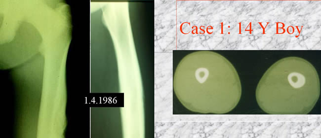 periostal ewing sarcoma