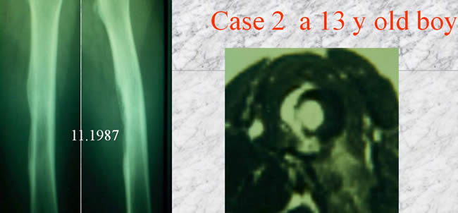 periostal ewing sarcoma