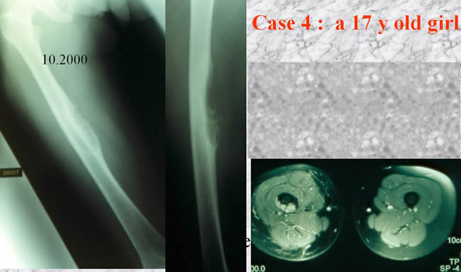 periostal ewing sarcoma