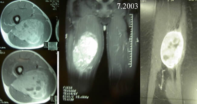 periostal ewing sarcoma