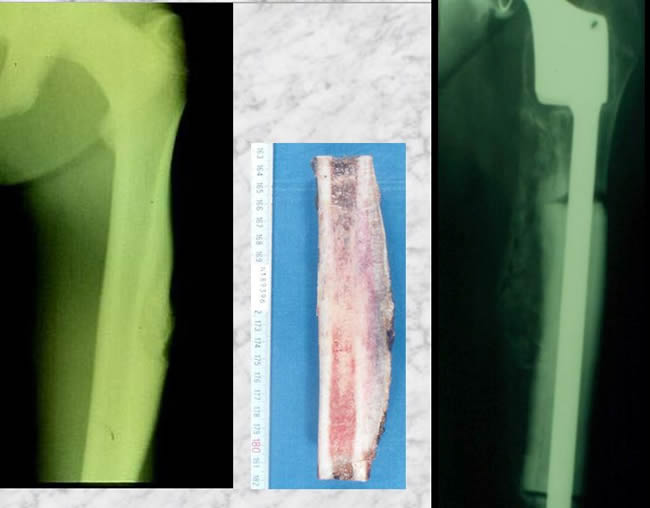 periostal ewing sarcoma