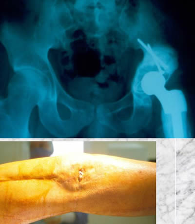 periostal ewing sarcoma