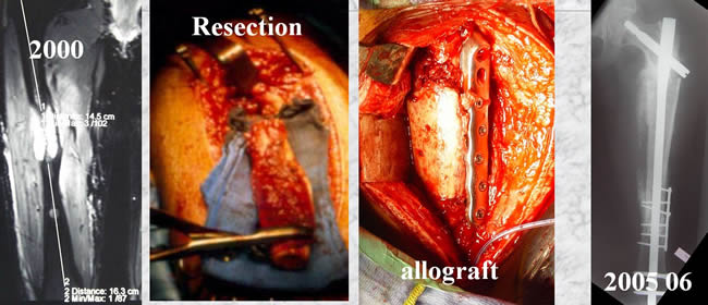 periostal ewing sarcoma