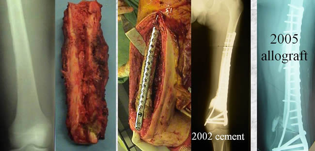 periostal ewing sarcoma