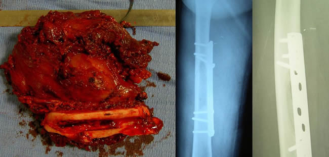 periostal ewing sarcoma