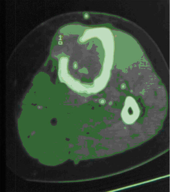 Calcifications Tumorales