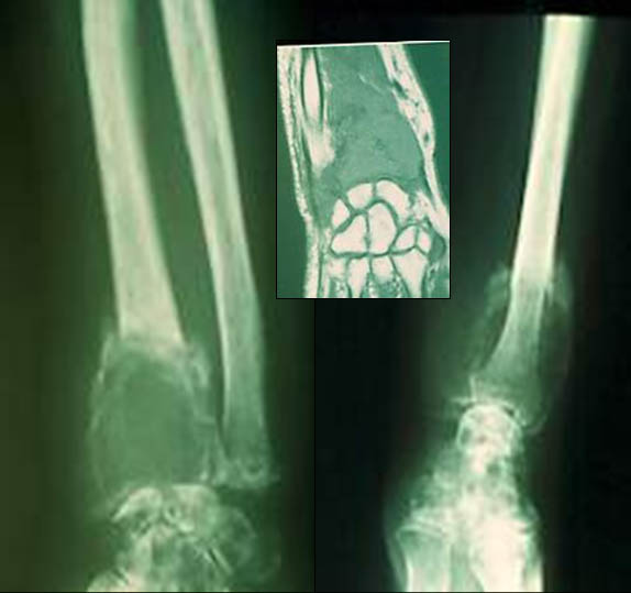 Fracture du radius distal