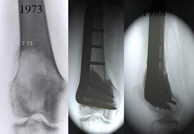 Fracture du calcanéum