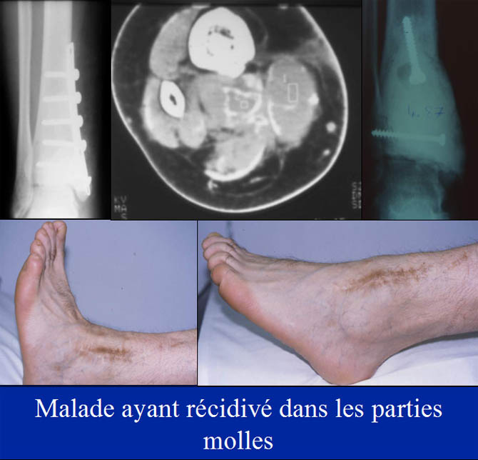 Enraidissement partiel