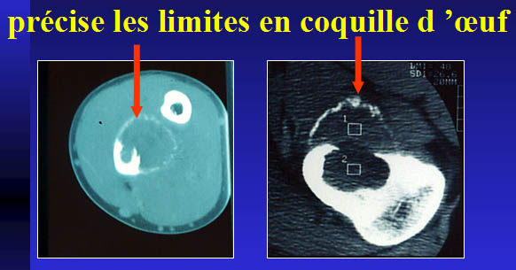 Limite en coquille d'oeuf