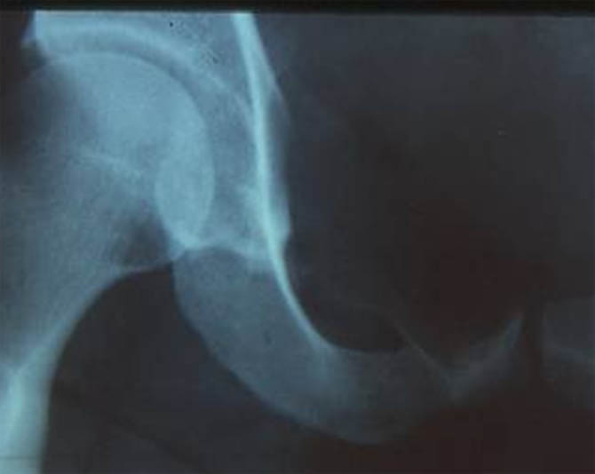 Radiographie du pubis