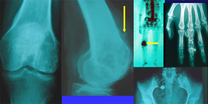 Enchondromatose multiple