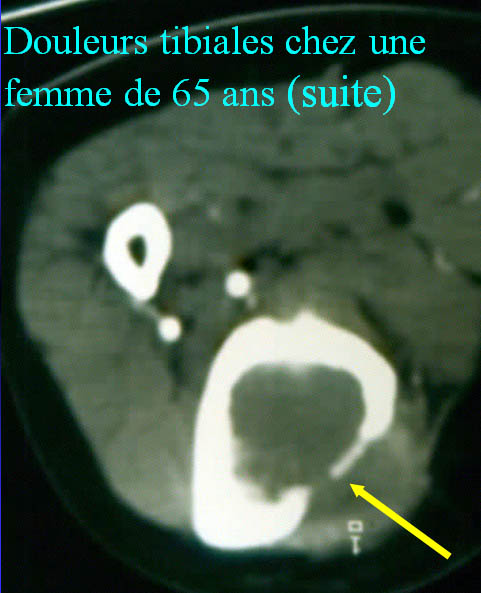 Scintigraphie tibia