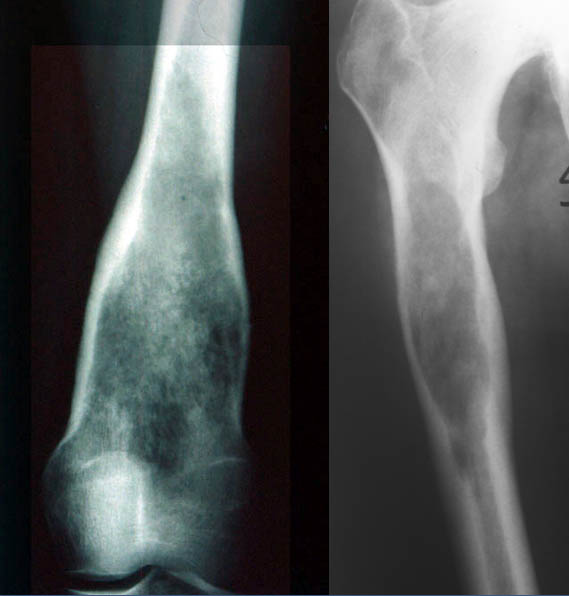 Calcifications et soufflures I