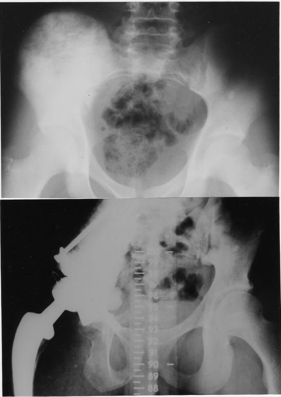 Osteosarcoma of right acetabulum