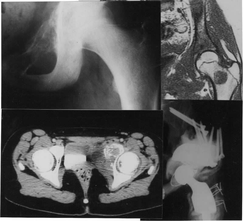 Ewing's sarcoma