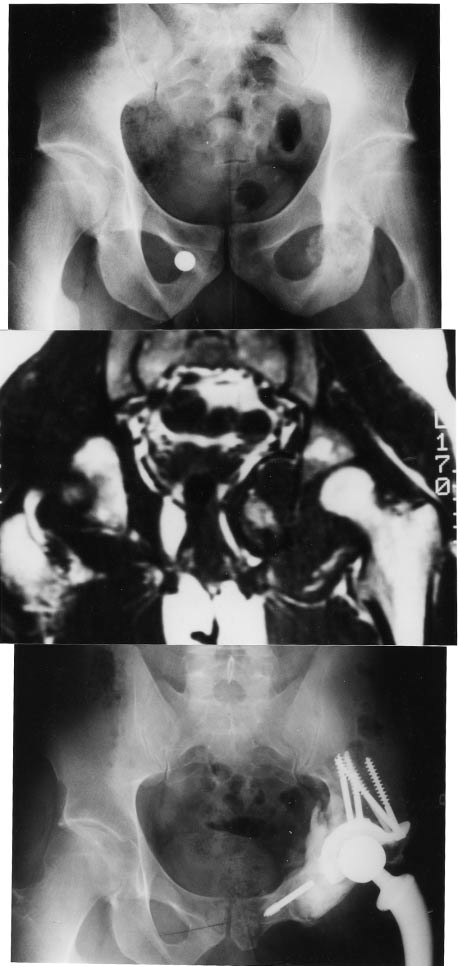 Osteosarcoma of the acetabulum and the obturator ring