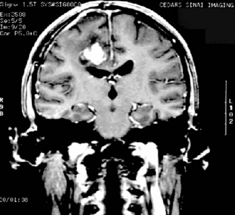 Glioblastoma