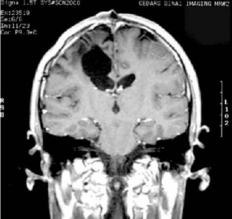 After curative resection