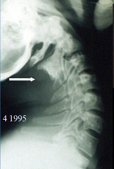 Rachis cervical