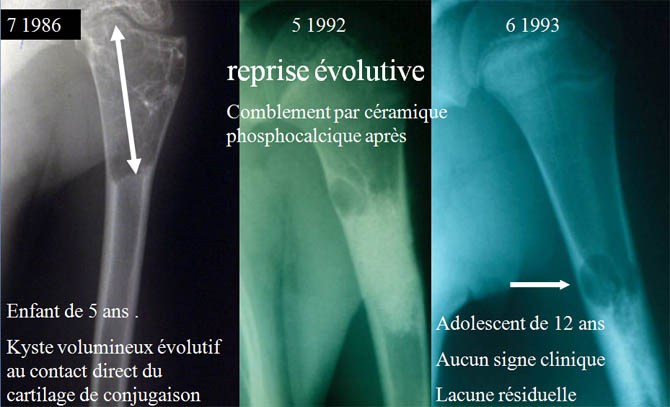 Curettage incomplet