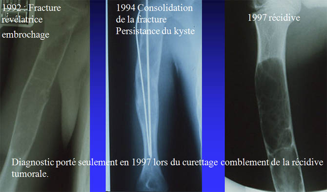 Risque de récidive après curettage