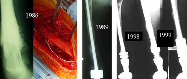 Secondary Lengthening