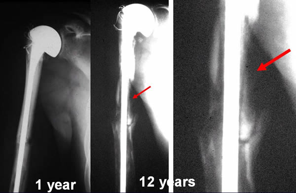 MAJOR RESORPTION