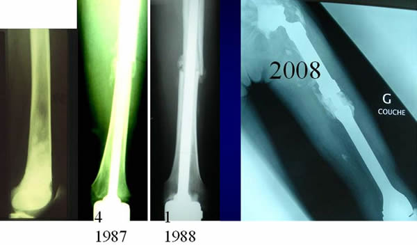 radiotherapy and chemotherapy