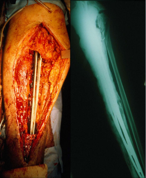 Spacer for promial tibia