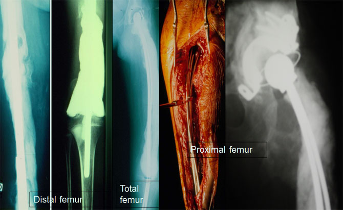 Spacer for femur