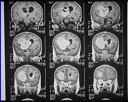 IRM of brain