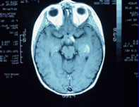 IRM of brain of child 3 months later