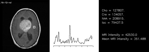 IRM of brain III