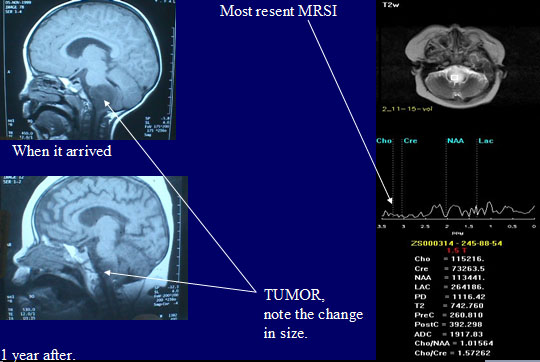MRS tumors II