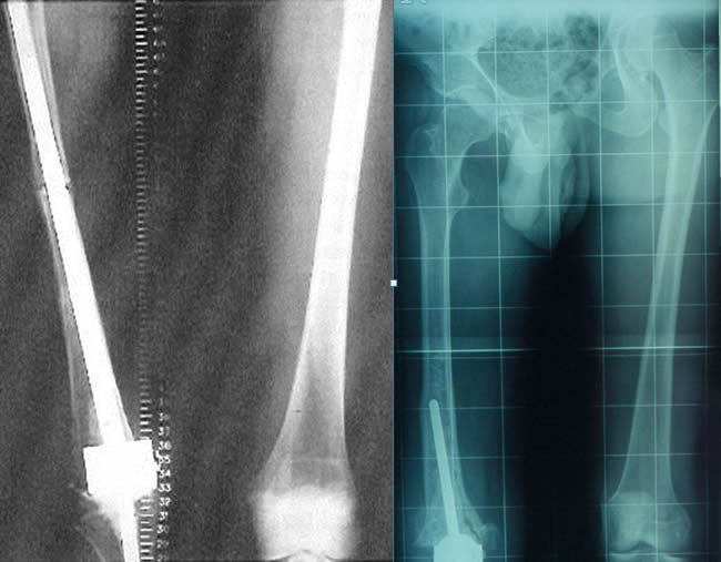 prosthesis implantation