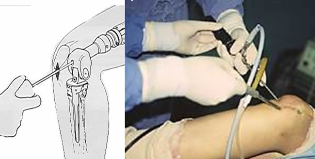 arthroscopic prosthesis