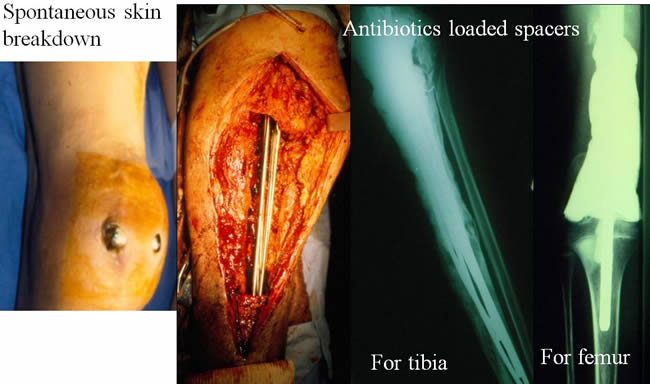 Orthopaedic complications