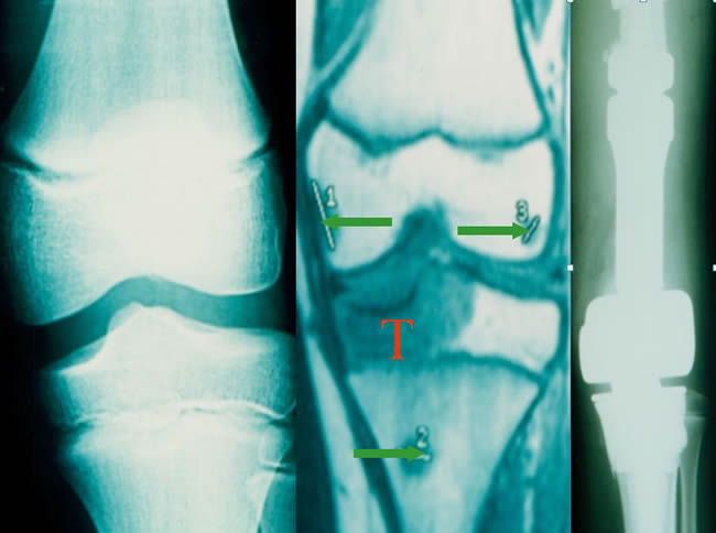 Bifocal Resection