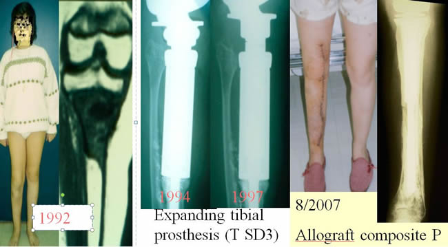 Osteosarcoma