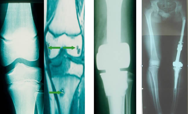 Bipolar Resection