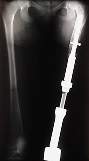 large lengthening bone